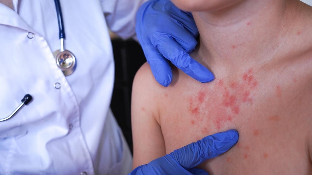 Minnesota's 80 measles cases this year are the most since 1990, health officials say — New Hope Health news