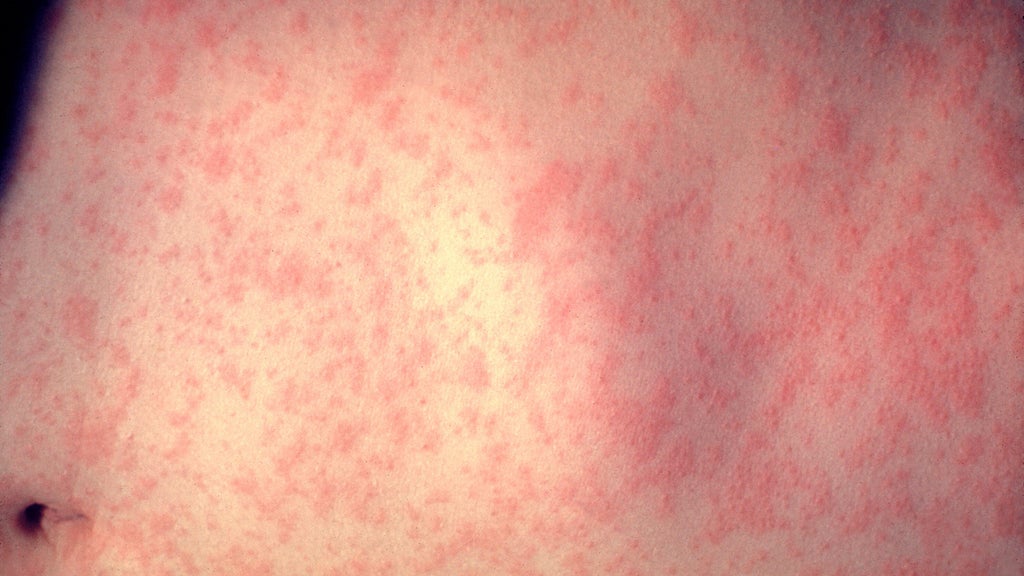 25 cases of measles identified in central, southeastern Minnesota, MDH says — WCCO / CBS Minnesota, New Hope Health news